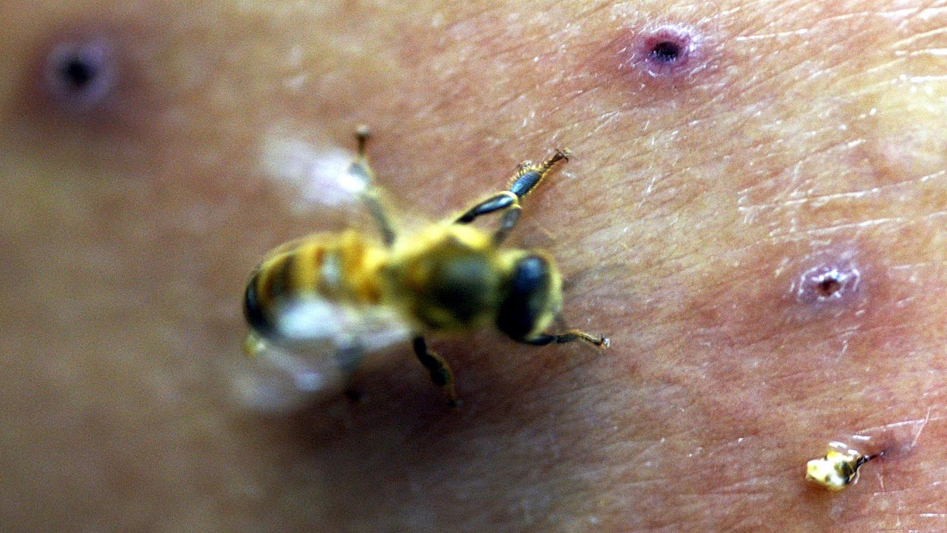 صورة بعنوان: الحساسية من الحشرات 