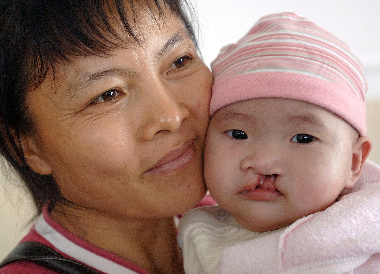 صورة بعنوان: الشفة المشقوقة والشق الحلقي 