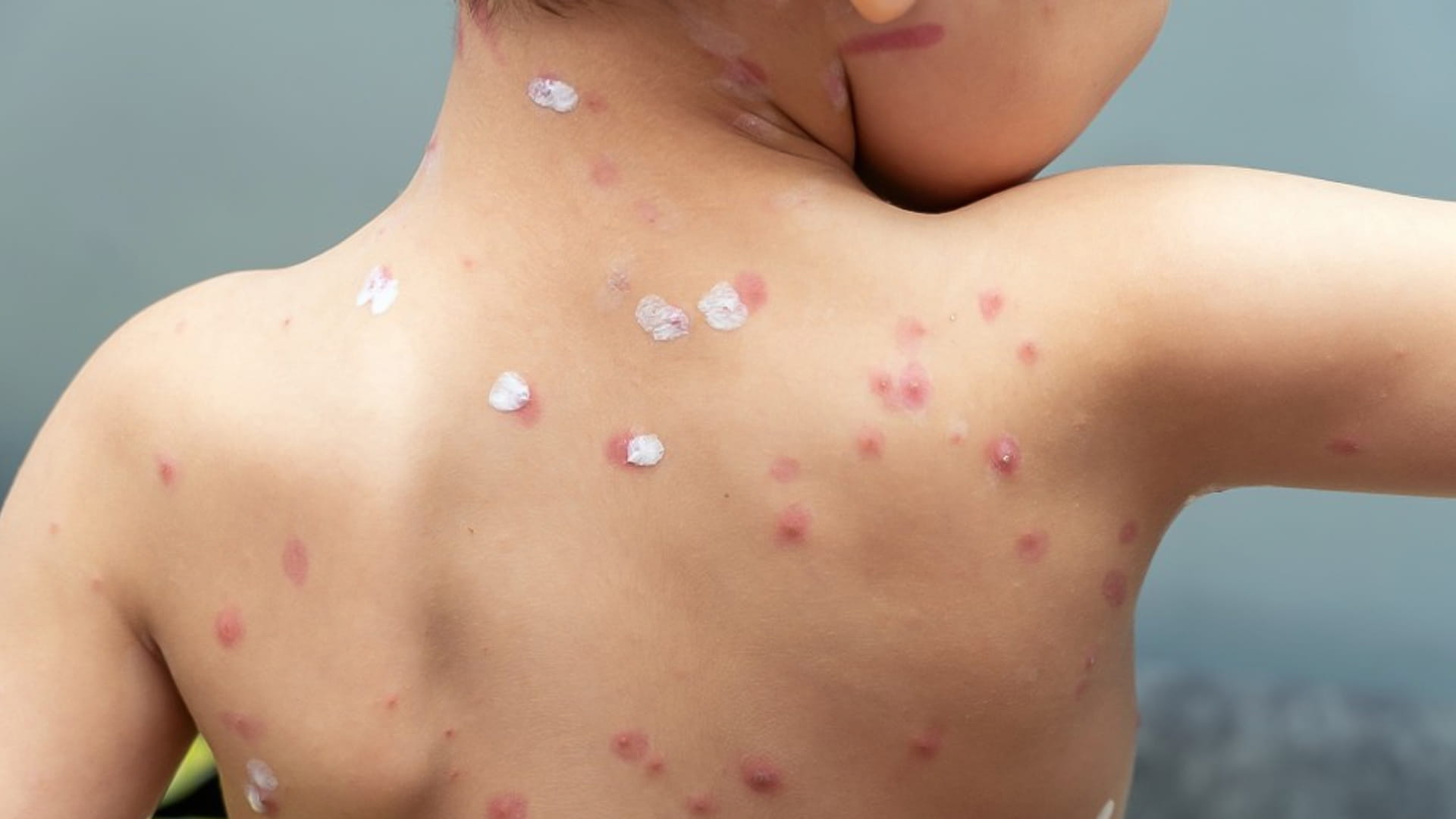 صورة بعنوان: مرض الجدري في الشارقة (1935م-1936م) 