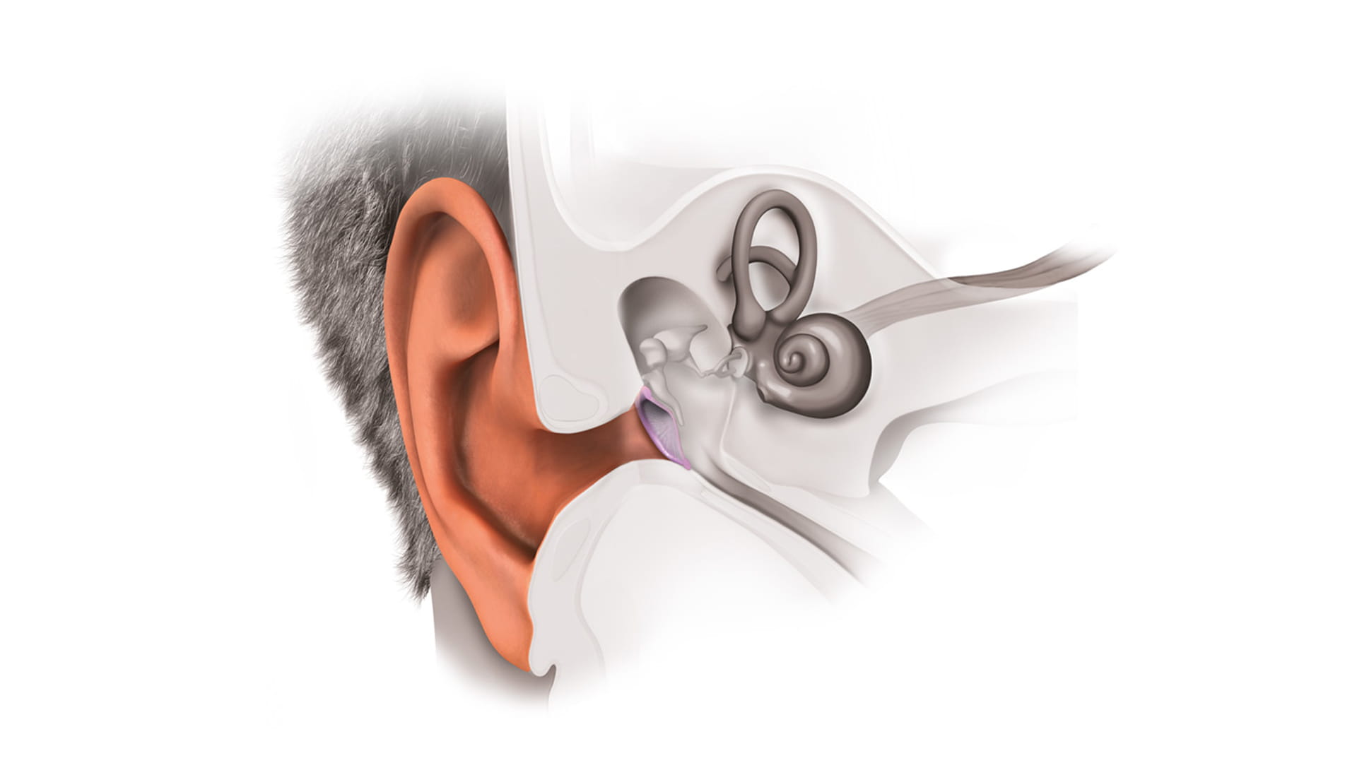 صورة بعنوان: تمزق طبلة الأذن 