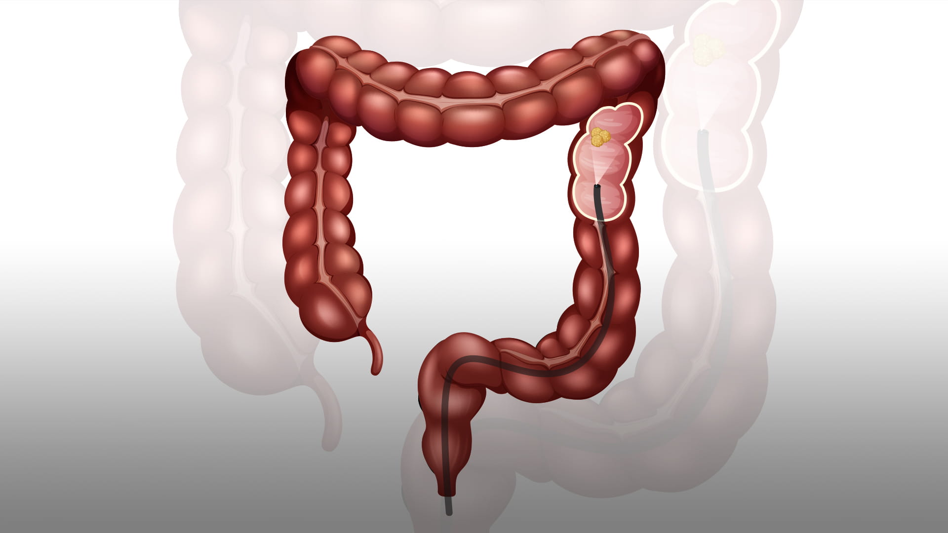 صورة بعنوان: منظار القولون  