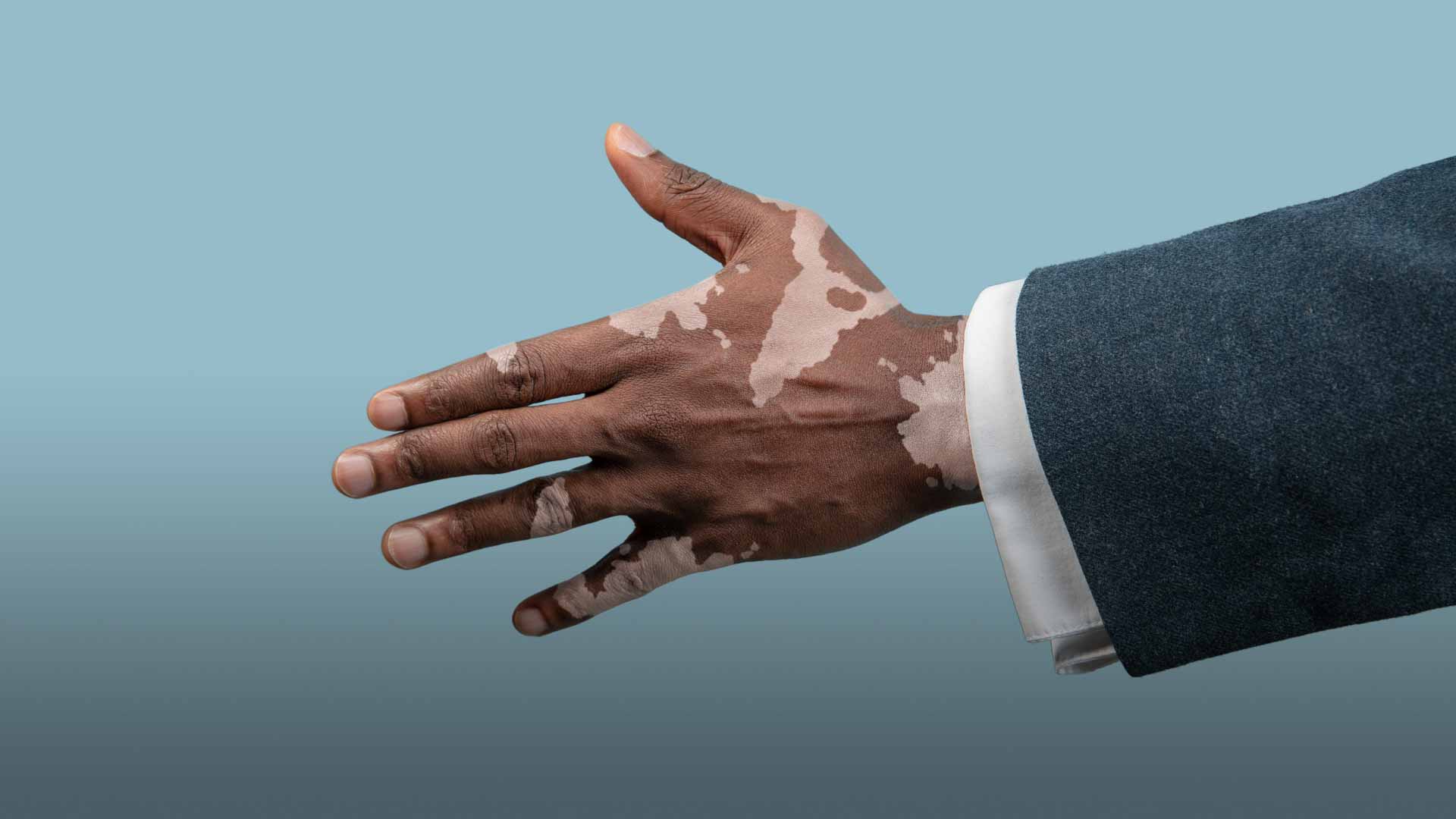 صورة بعنوان: طبيعة مرض البُهاق وطرق علاجه 