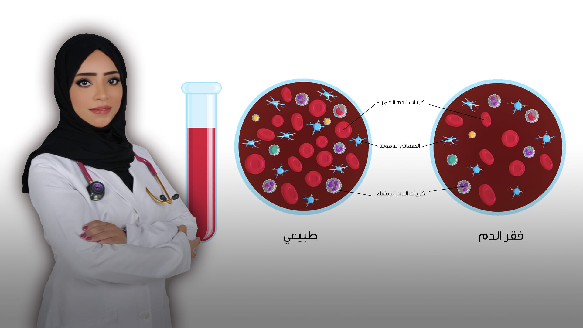 صورة بعنوان: فقر الدم الناتج عن نقص الحديد  