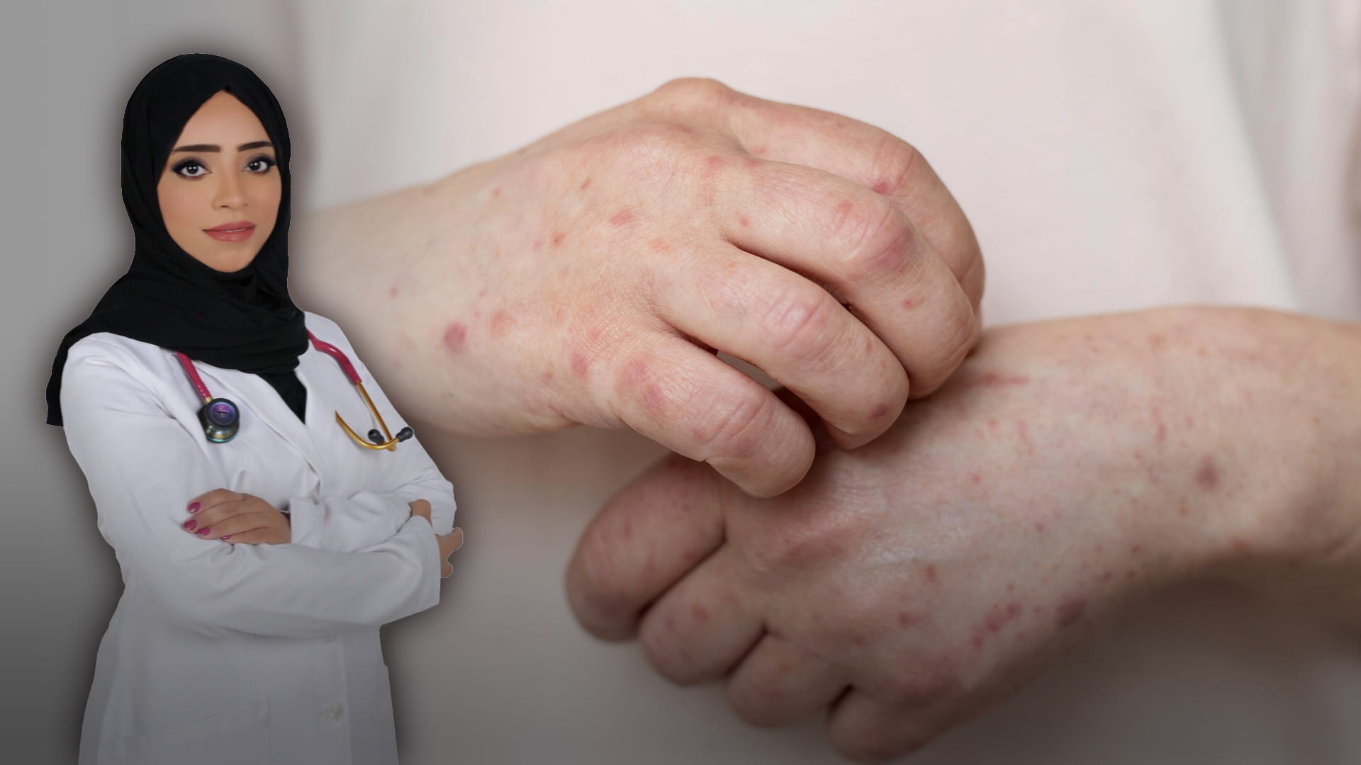 صورة بعنوان: مرض اليد والقدم والفم  