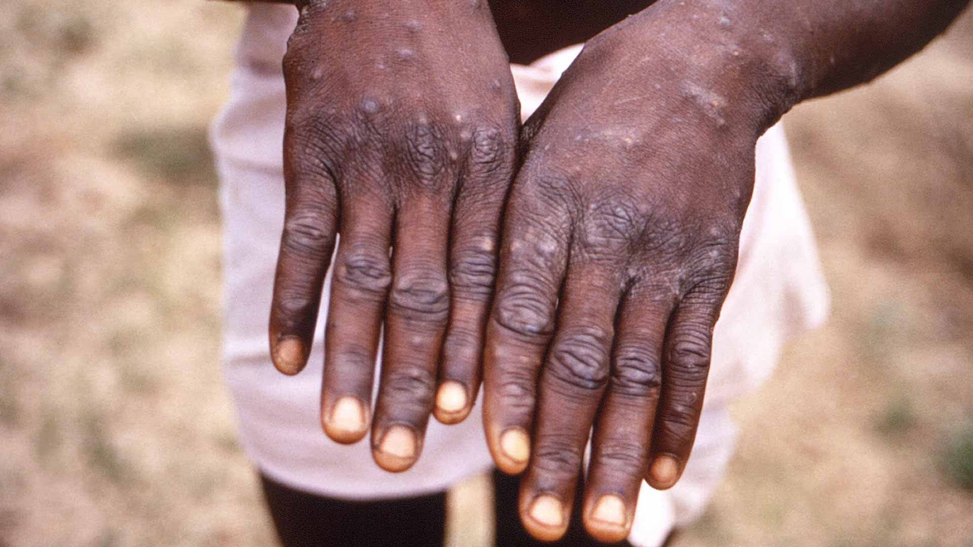 صورة بعنوان: أستراليا ترصد حالة عدوى محتملة بجدري القرود لمسافر عائد من أوروبا 