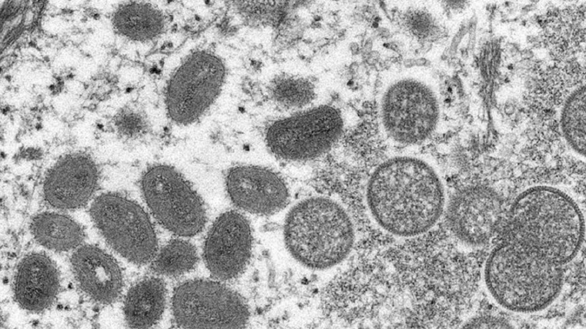 Image for the title: New monkeypox cases take UK total to 20 