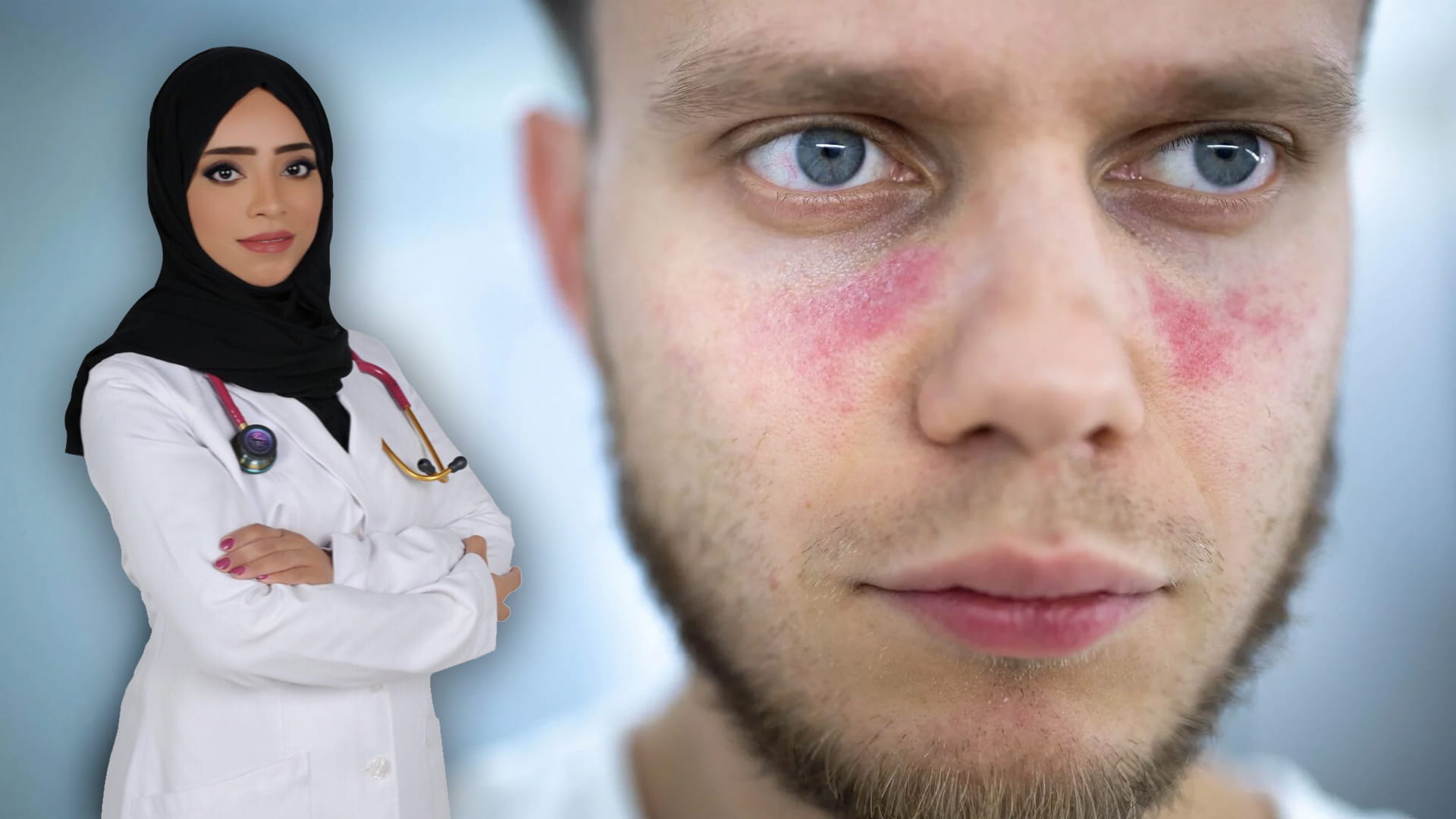 صورة بعنوان: الذئبة الحمراء " Systemic lupus erythematosus" 