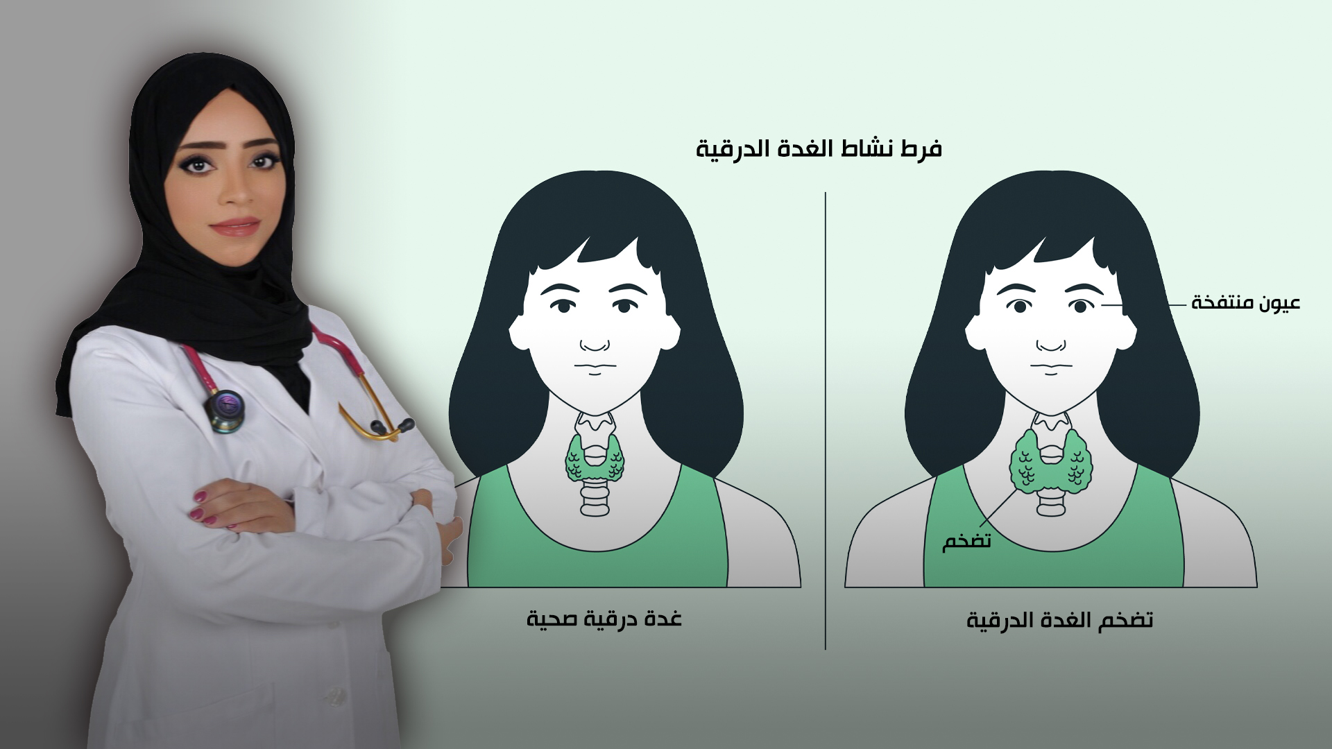 صورة بعنوان: خمول الغدة الدرقية 