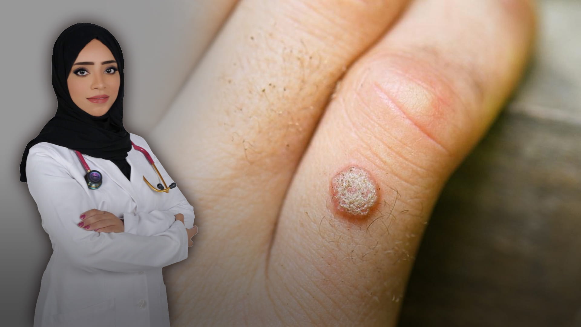 صورة بعنوان: الثآليل الجلدية 