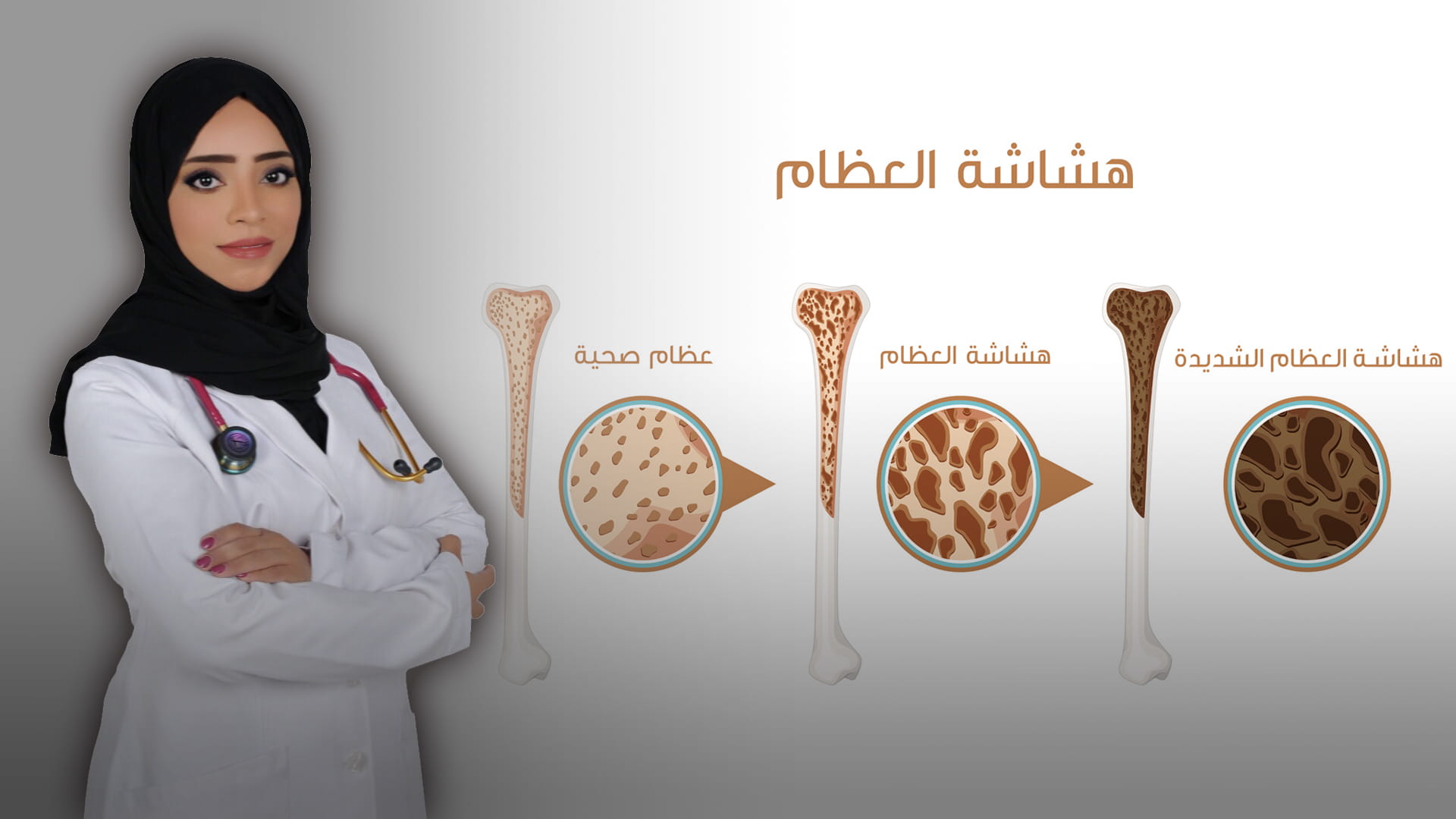 صورة بعنوان: هشاشة العظام 