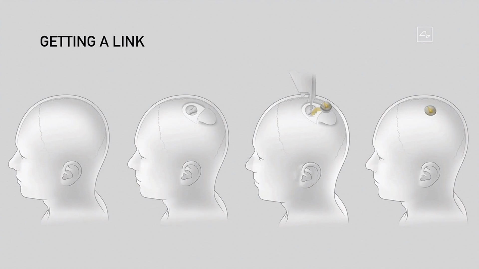 Image for the title: Musk expects Neuralink’s first implantation in humans this year 