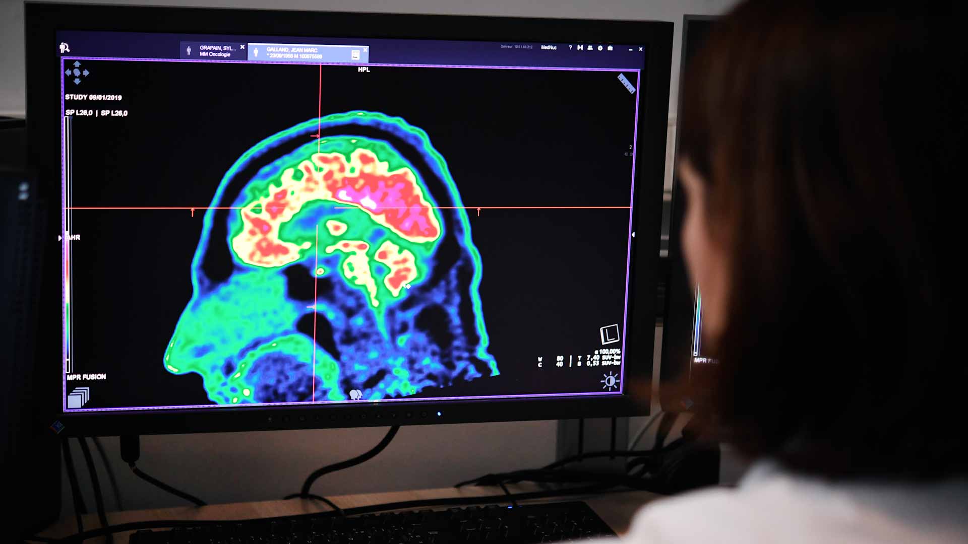 صورة بعنوان: باحثون يطورون وسيلة علاجية جديدة للقضاء على أورام المخ 