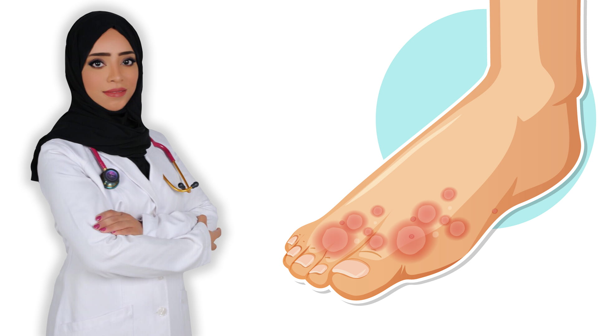 صورة بعنوان: مرض القدم الرياضي "فطريات القدم" 