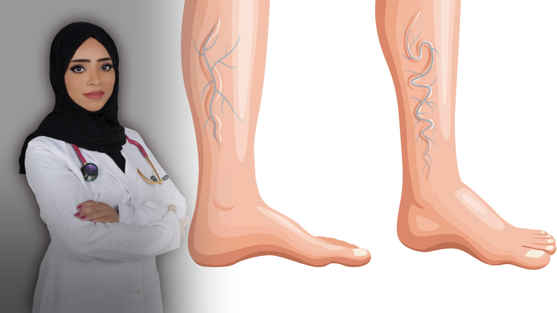 صورة بعنوان: دوالي الساقين 