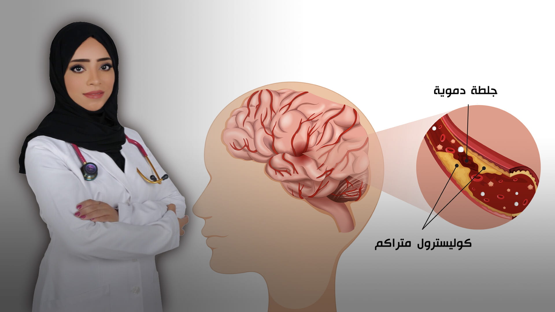 صورة بعنوان: الجلطة الدماغية..كيفية تشخيصها وطرق علاجها  