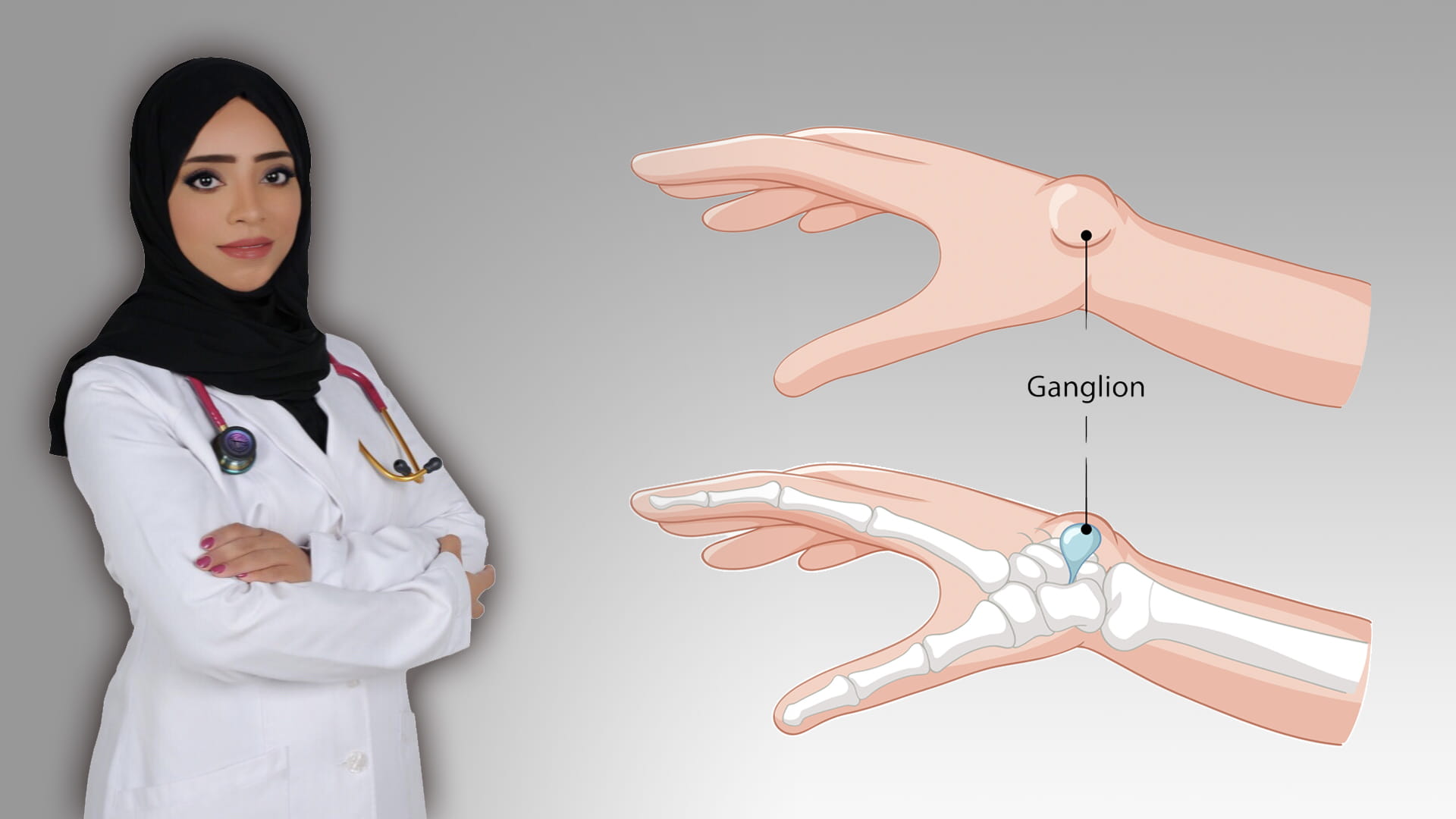 صورة بعنوان: الكيس العقدي 