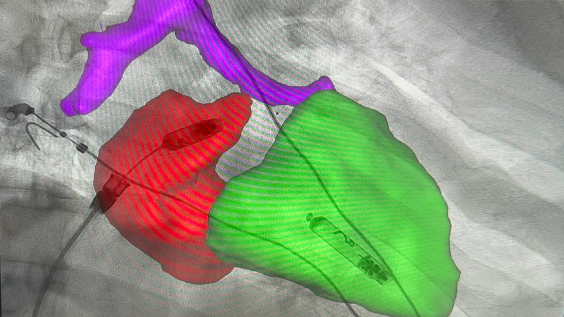 Image for the title: AQH implants permanent wireless dual-chamber pacemaker for patient 
