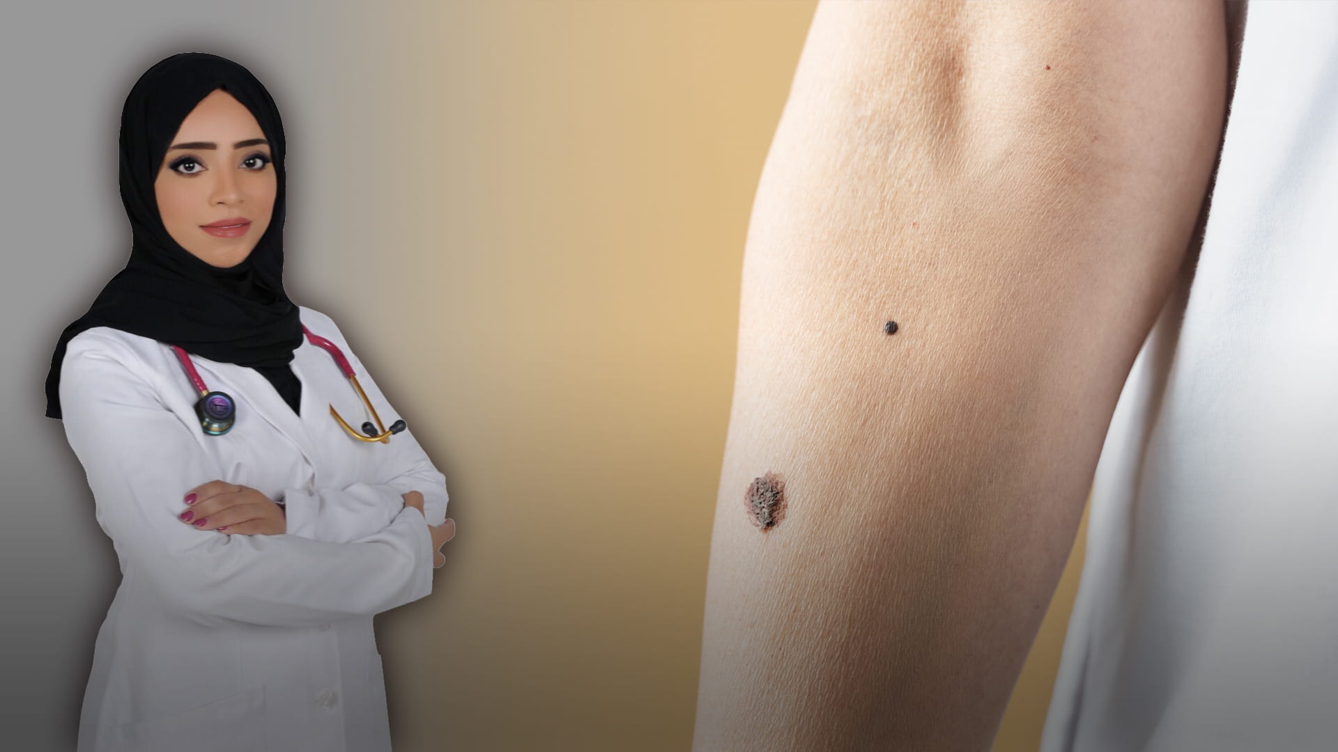 صورة بعنوان: الشامة... ماذا تعرف عنها؟ 