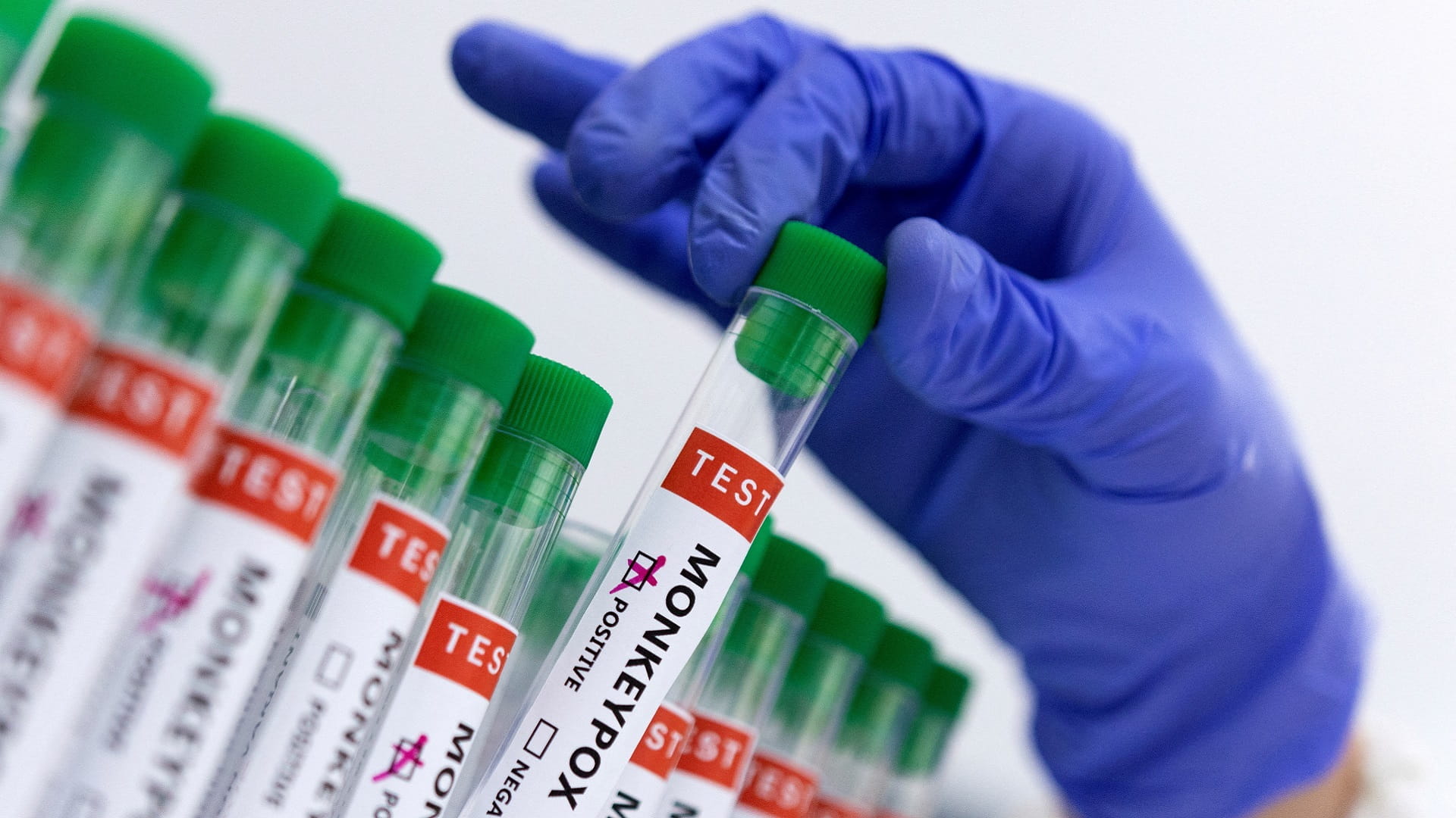 الأردن تسجل إصابة بجدري القردة 