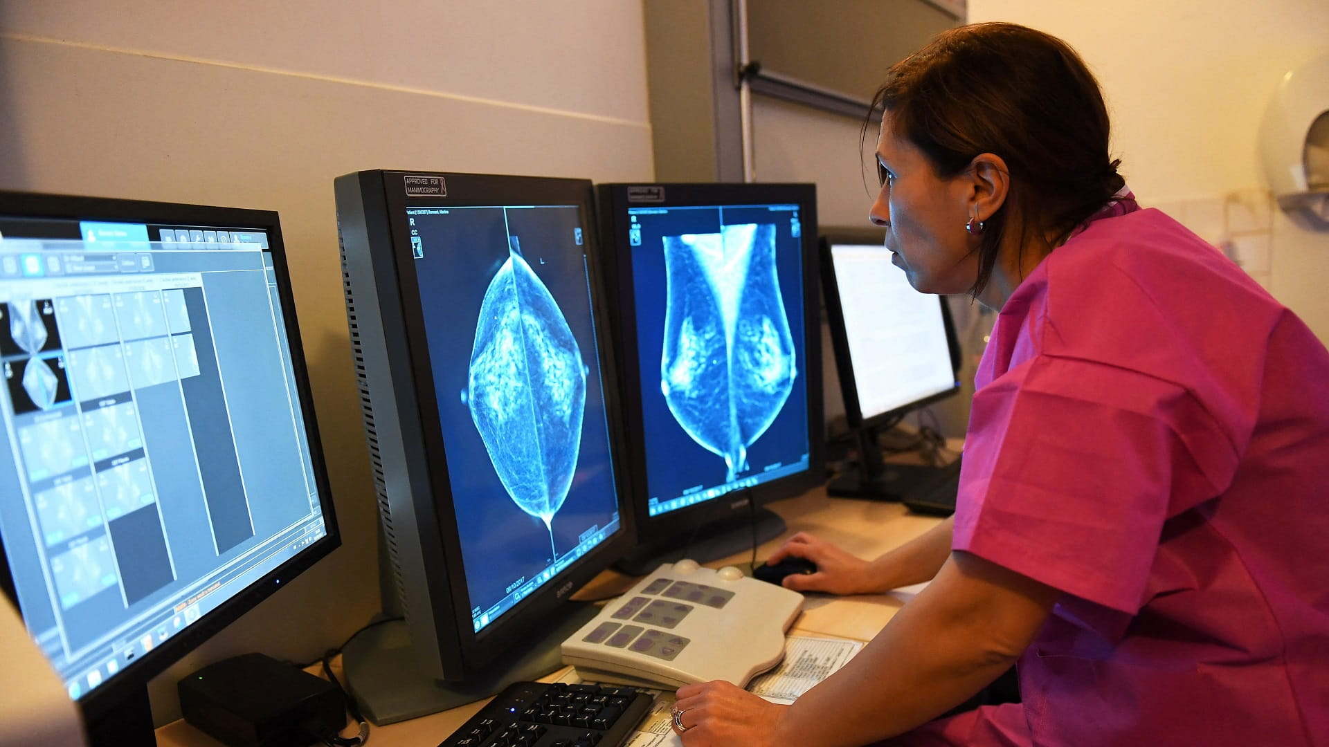 Study: Artery findings in Mammograms may signal heart disease 