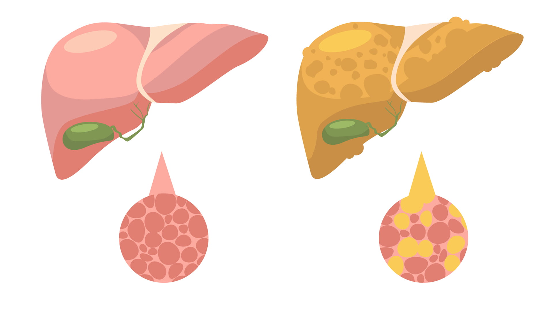 باحثون أميركيون يطورون دواء لعلاج تلف الكبد والالتهابات المزمنة 