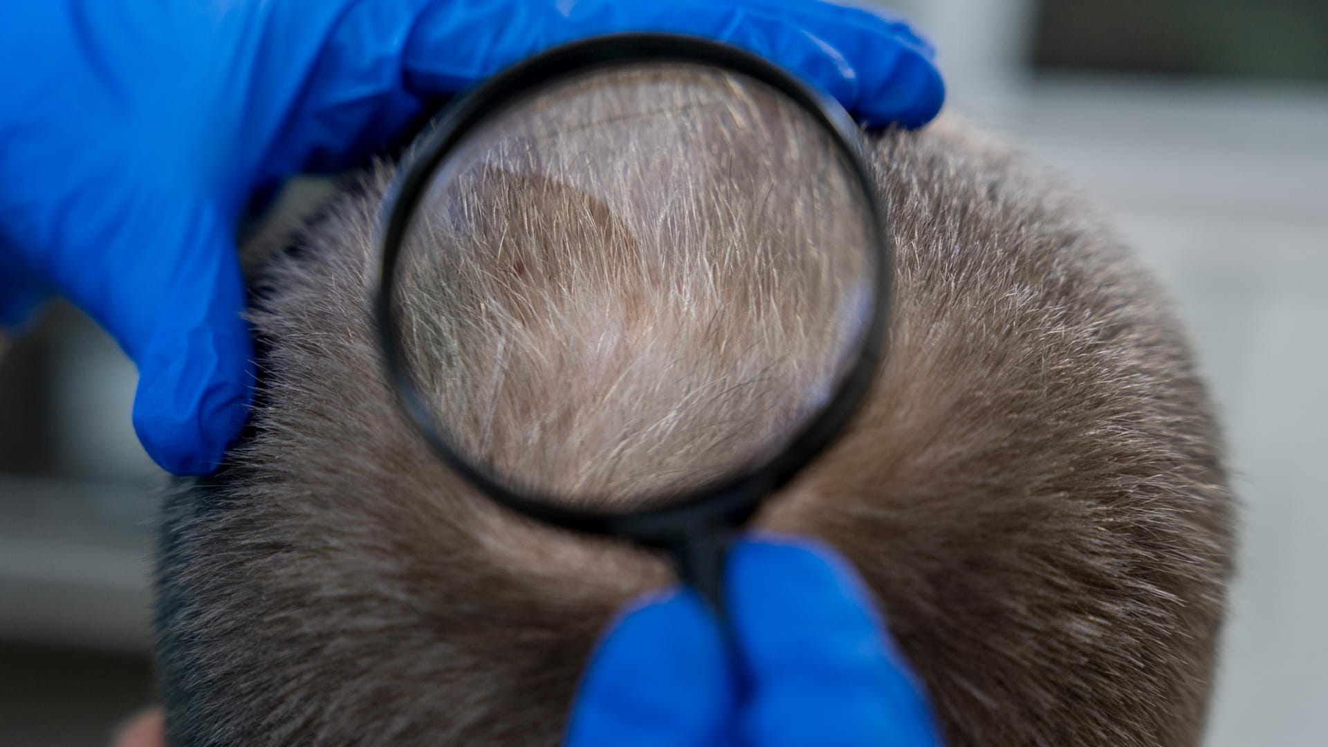 بنتائج واعدة.. عقار "كلاسكوتيرون" الجديد يعالج الصلع الوراثي 