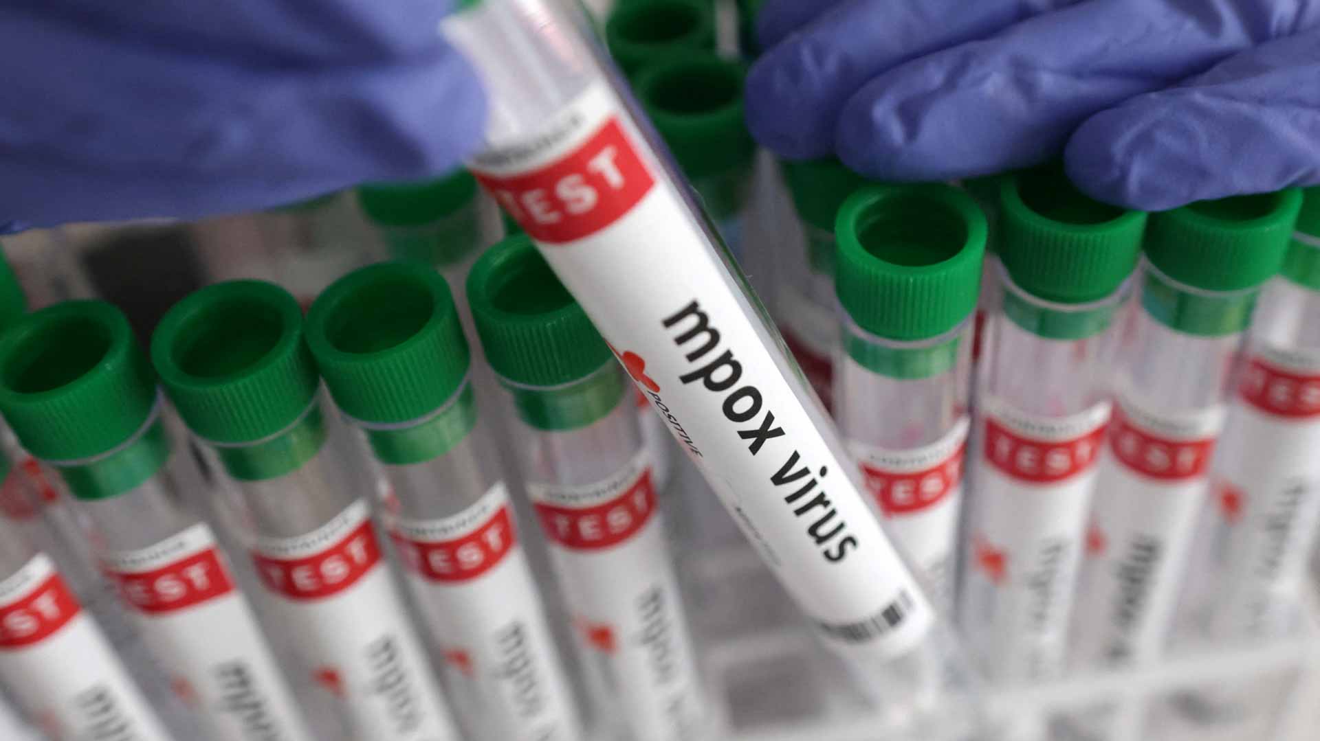  بانتكاسة صحية.. نيويورك تسجل أول إصابة بسلالة جدري القردة الجديدة 