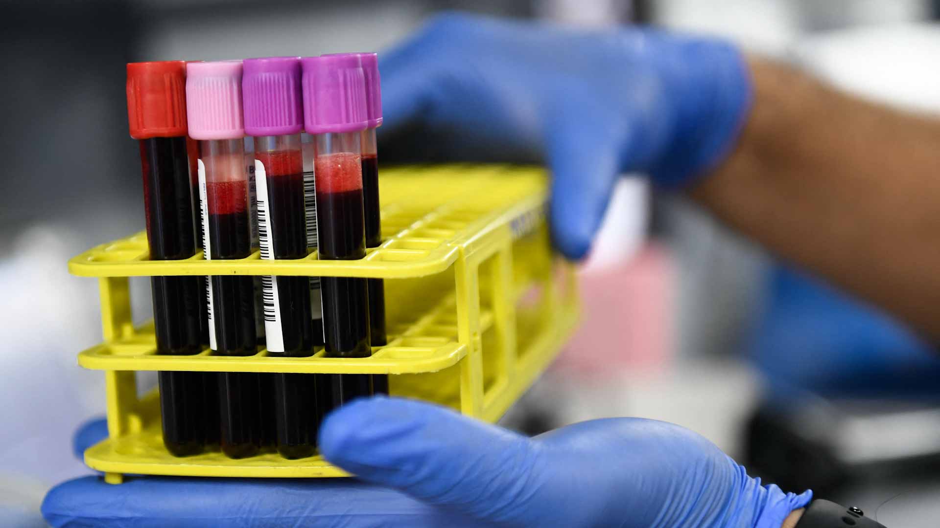 دراسة تكشف: حاملو فصيلة الدم A أكثر عرضة لسرطان الثدي 