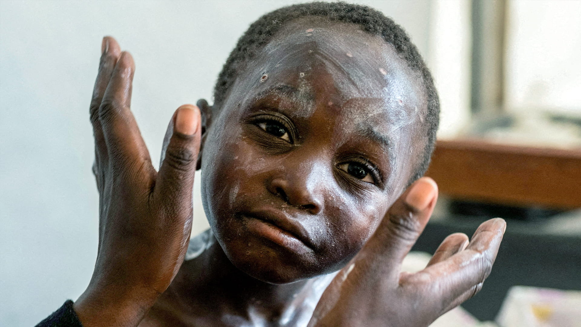 "منظمة الصحة" تعلن انتهاء حالة الطوارئ العالمية لجدري القرود 