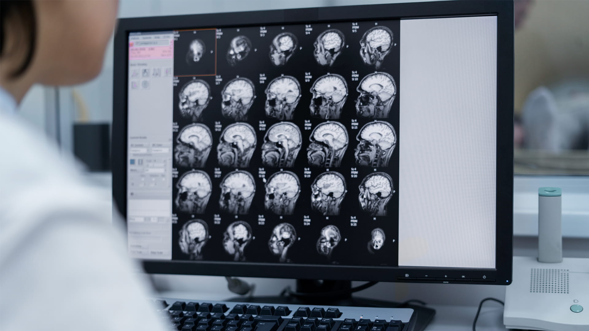 في اكتشاف واعد.. علماء روس يبتكرون نموذجًا حاسوبيًا لعلاج الصرع 