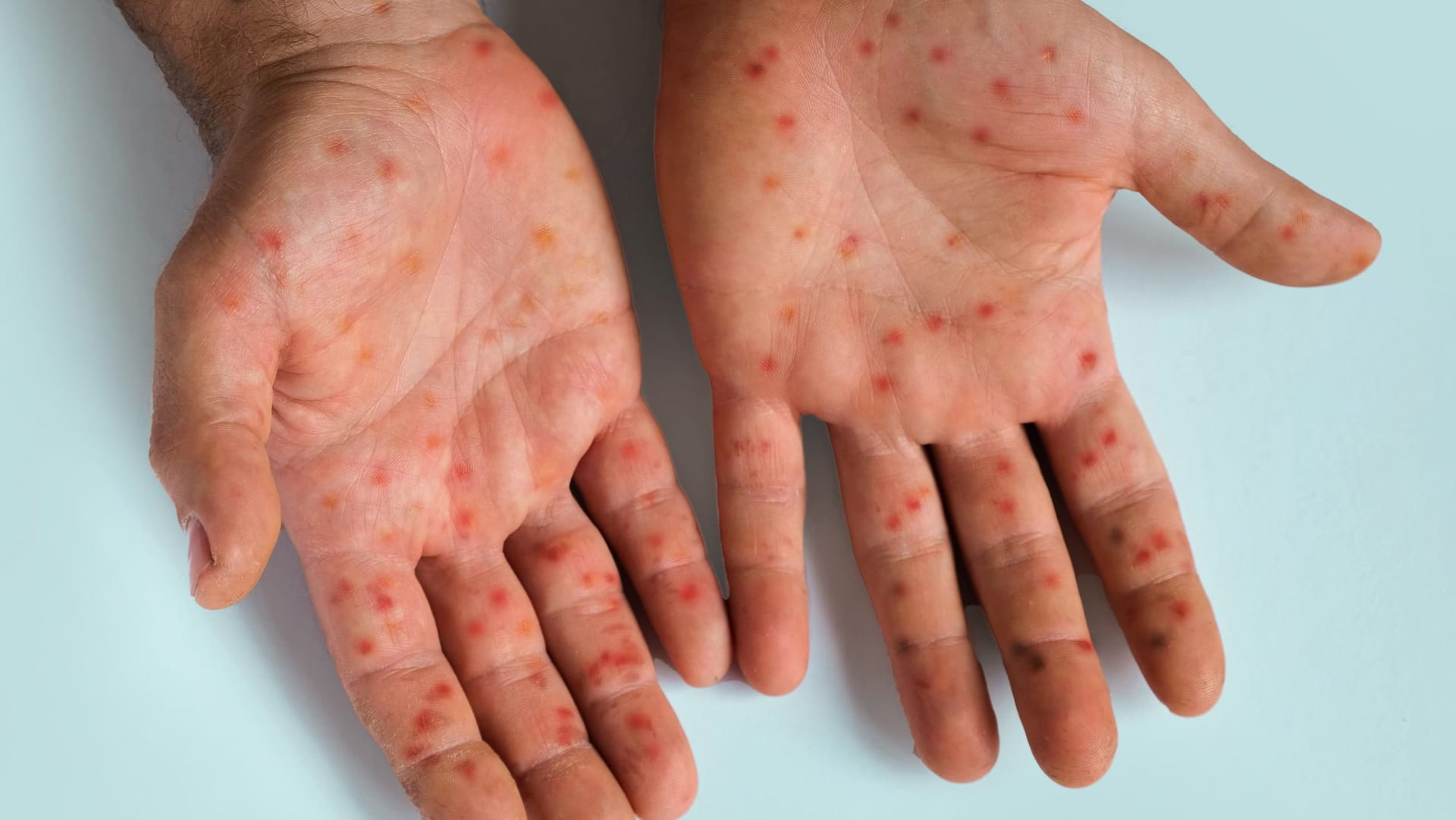 ارتفاع حاد في إصابات ووفيات حمى الضنك بأنحاء بنغلادش 