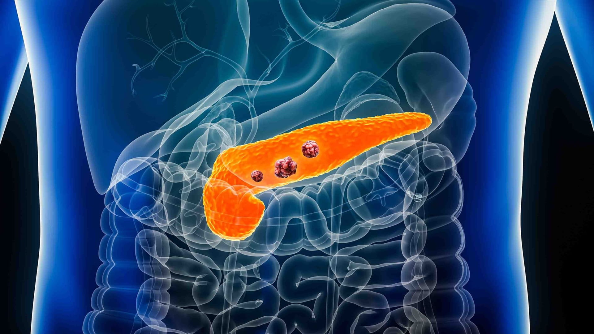Promising US drug offers hope for pancreatic cancer patients