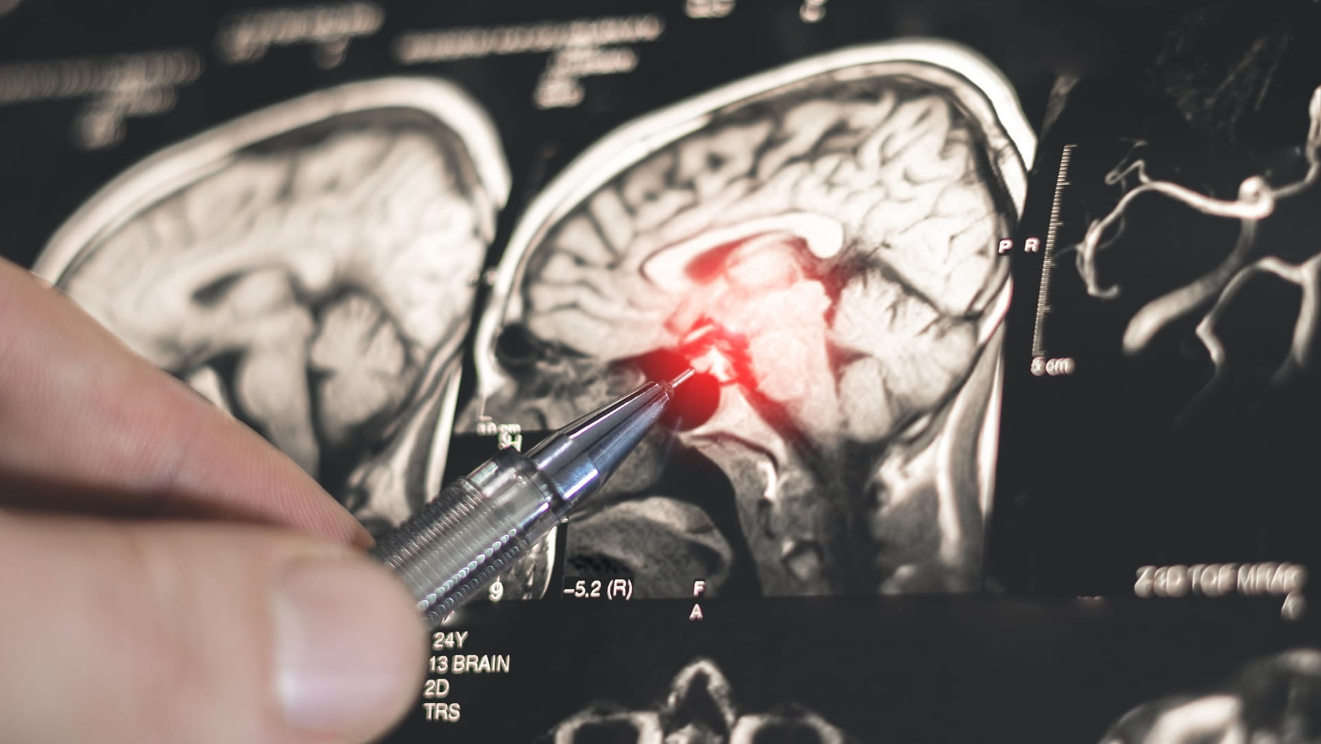 اكتشاف روسي جديد يفتح الطريق لتطوير أدوية لعلاج باركنسون